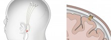 Neuralink. Elon Musk �potenzia� l�uomo con il pc