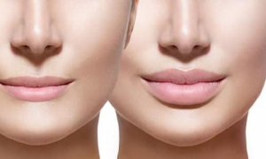 Stop ai &quot;ritocchi&quot; per i minorenni, l'Inghilterra vieta botox e filler per le labbra