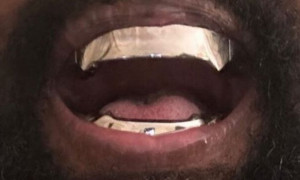 Un protesi in titanio al posto dei denti per Kanye West?