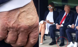Usa, Casa Bianca: &quot;Trump ha un'insufficienza venosa cronica&quot;