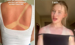 Follia Social: Procurarsi scottature al sole per evidenziare le linee del costume