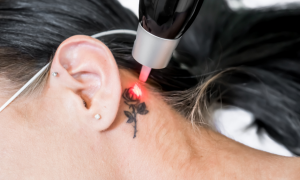 Addio ai tatuaggi: sempre pi&ugrave; vip scelgono di cancellarli