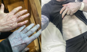 Si sveglia con la pelle blu e corre al pronto soccorso