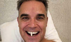 Robbie Williams, incidente domestico virale: perde un dente e ironizza sui social
